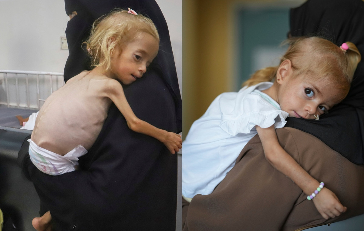 Shocking pictures: Gaza little girl with rare illness recover from malnutrition in Italy – smiles after a month