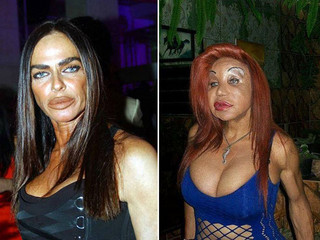 plastic_surgery_fails_6