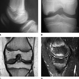 osteoch03