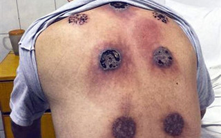 cupping-therapy
