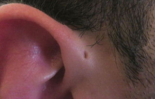 Οι άνθρωποι που γεννιούνται με μια μικροσκοπική τρύπα στο αυτί