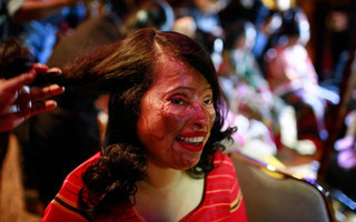 BANGLADESH_ACIDSURVIVORS12