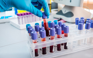 Τεστ αίματος με τεχνητή νοημοσύνη βρίσκει τον  καρκίνο του ήπατος