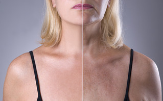 Γυναικείο πρόσωπο πριν και μετά από μέθοδο αντιγήρανσης