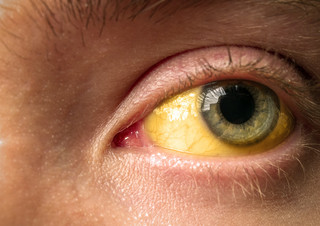 Ηπατίτιδα, κίτρινο μάτι