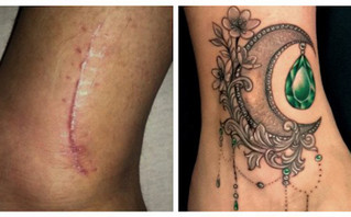 Σημάδια που καλύφθηκαν από τατουάζ