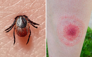 Βορρελίωση ή νόσος Lyme: Η αρρώστια από τα τσιμπούρια που έχει το 14% των ανθρώπων στη Γη