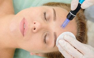 Microneedling - περιποίηση προσώπου