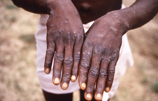 Ιός Mpox Ιός Mpox
