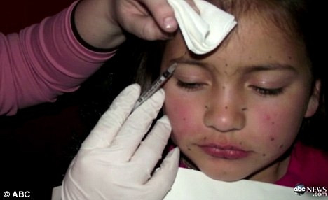 Botox σε 8χρονη