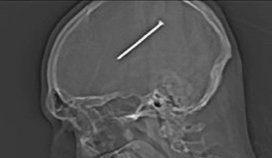Ξυλουργός βρέθηκε με καρφί 8 εκατοστών στον εγκέφαλο!