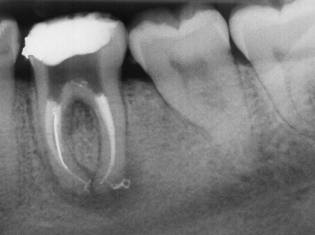 Επικίνδυνες οι συχνές ακτινογραφίες δοντιών