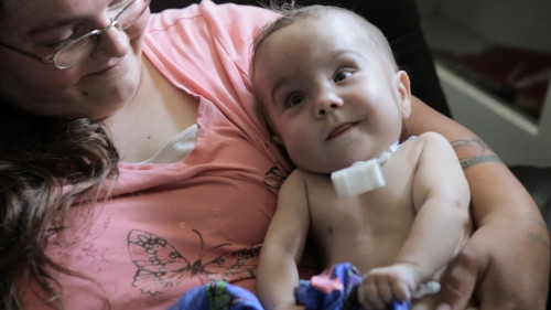 Τρισδιάστατη εκτύπωση σώζει τη ζωή μωρού 2 μηνών
