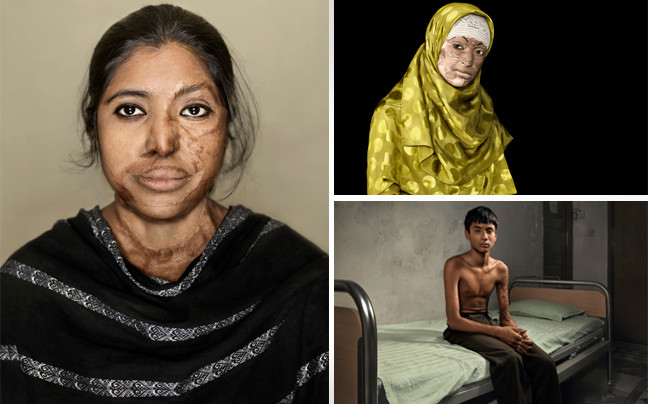 Συγκλονιστικές εικόνες ανθρώπων που γλίτωσαν από επιθέσεις με οξύ