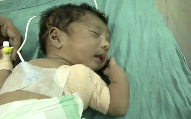 Μωρό με τρία χέρια γεννήθηκε στην Ινδία