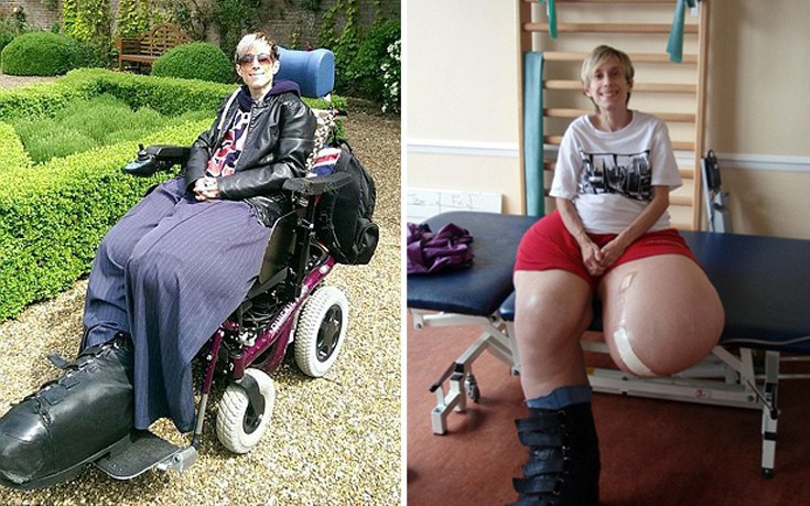 Η γυναίκα με τα πόδια που ζύγιζαν 107 κιλά μιλάει για τη συρρίκνωσή τους μετά από 40 χρόνια