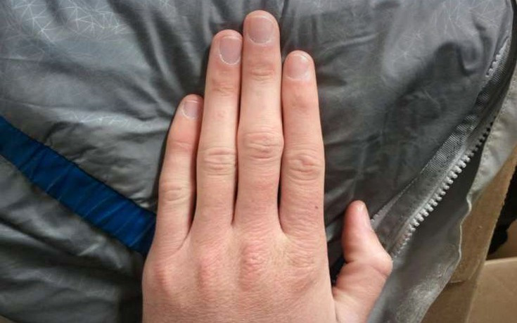 Θεσσαλονίκη: 15χρονος απέκτησε και πάλι τα δάχτυλα του δεξιού του χεριού