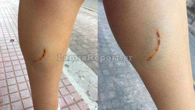 Λαμία: Νεαρή αθλήτρια δέχτηκε επίθεση από αδέσποτο σκυλί