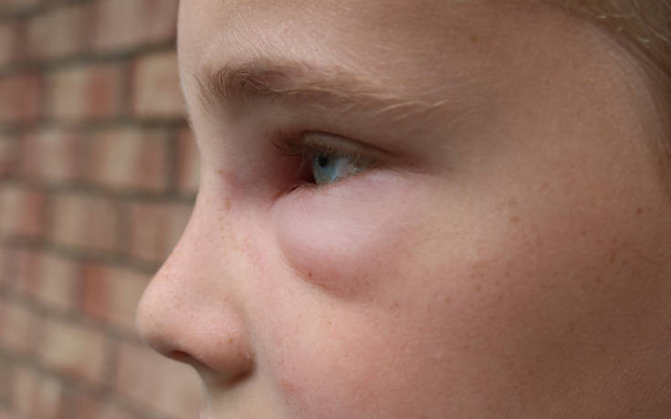 Το 7χρονο αγόρι που είναι αλλεργικό στον χειμώνα