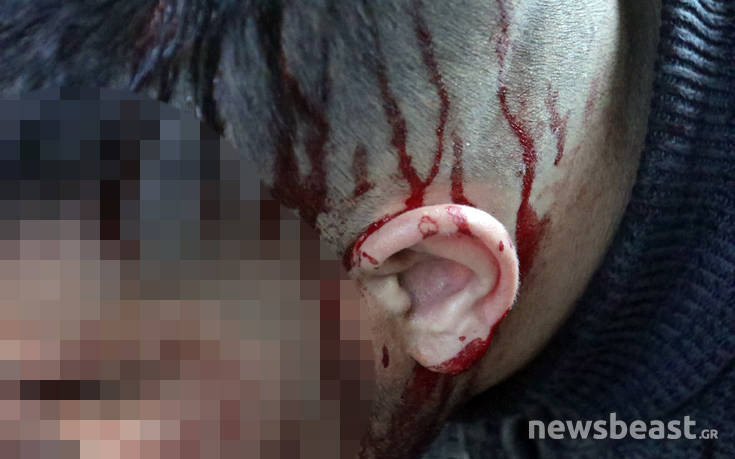Φοιτητής τραυματίστηκε στο κεφάλι στις συμπλοκές με τα ΜΑΤ στο Καβούρι