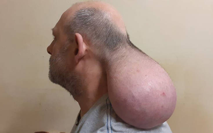 Κρατούμενος στις φυλακές Νιγρίτας Σερρών έχει όγκο που μοιάζει με&#8230; δεύτερο κεφάλι