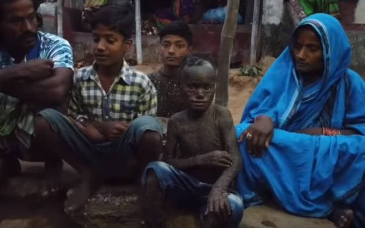Δεκάχρονο αγόρι στην Ινδία με δέρμα φιδιού: Η σπάνια ασθένεια και οι σοκαριστικές εικόνες