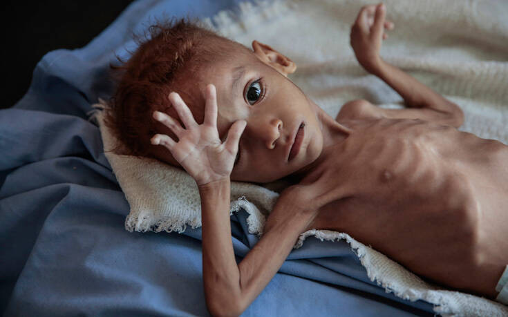 Τα παιδιά της Υεμένης λιμοκτονούν και ο φόβος ενός λιμού αναδύεται