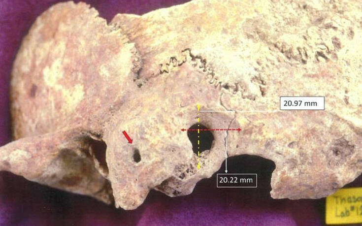 Αρχαιολογική ανακάλυψη στη Θάσο: Στο φως κρανίο πρωτοβυζαντινής περιόδου με ίχνη πολύπλοκης χειρουργικής επέμβασης