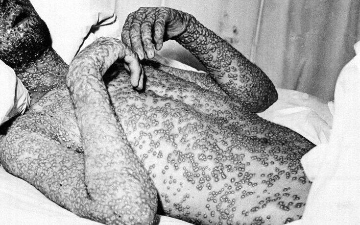 Όταν η επιδημία της ευλογιάς συγκλόνισε τη Γιουγκοσλαβία το 1972