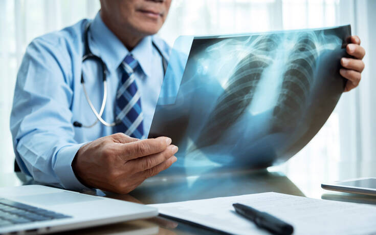 Σύστημα τεχνητής νοημοσύνης μπορεί να διαγνώσει τον καρκίνο των πνευμόνων έως και ένα χρόνο νωρίτερα