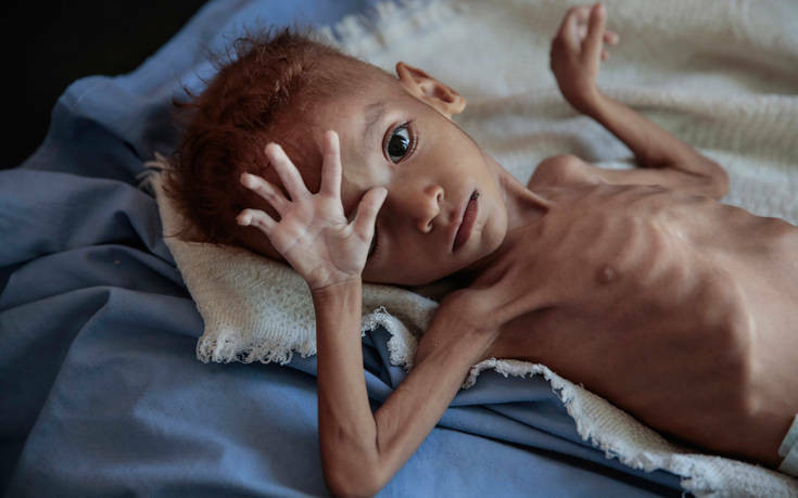 Καμπανάκι από τον ΟΗΕ για τον υποσιτισμό παιδιών στην Υεμένη: «Έχει φτάσει σε πρωτόγνωρα επίπεδα»