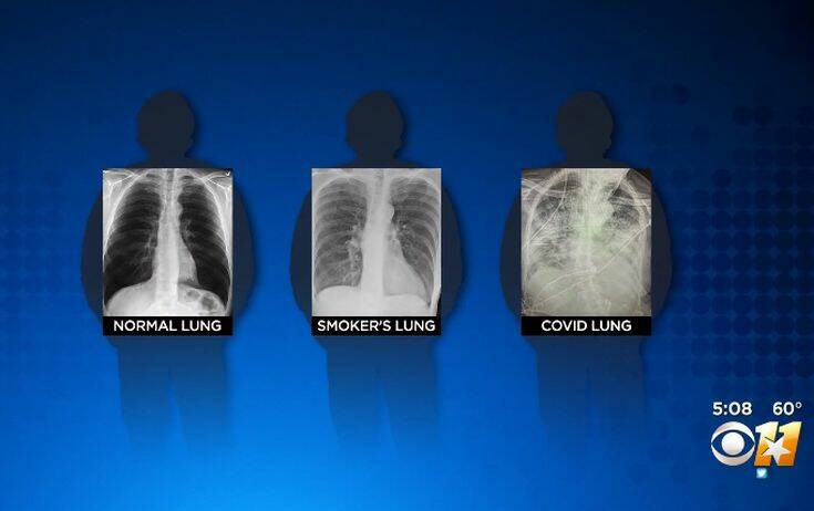 Έτσι είναι οι πνεύμονες ενός ασθενή με κορονοϊό, ενός καπνιστή και ενός υγιούς ανθρώπου