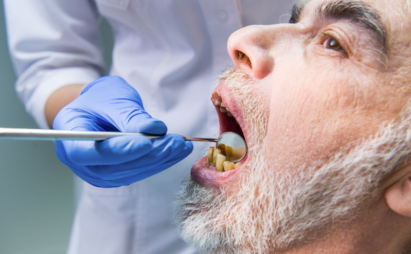 Η απώλεια δοντιών σχετίζεται με αυξημένο κίνδυνο για άνοια
