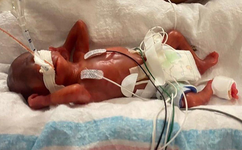 Μωρό ρέκορντμαν: Γεννήθηκε στις 21 εβδομάδες ζυγίζοντας 420 γραμμάρια και έζησε &#8211; Μπήκε στο βιβλίο Γκίνες