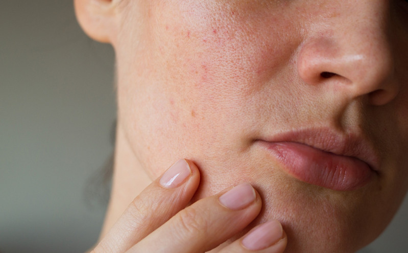 Τι προκαλεί πραγματικά την ακμή γύρω από το στόμα σας