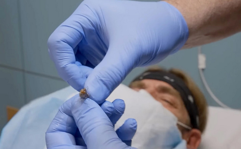 Τρομακτικό βίντεο: Γιατροί αφαιρούν μια νυχτοπεταλούδα από το αυτί