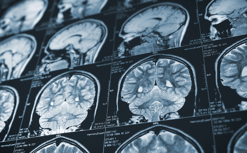 Παραισθήσεις και πονοκέφαλοι: Οι 7 νευρολογικές επιπτώσεις του κορονοϊού - Πώς επηρεάζεται ο εγκέφαλος