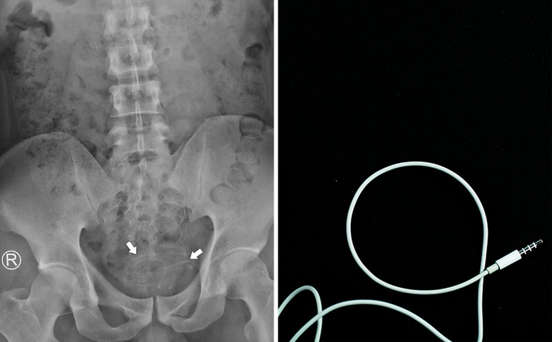 Πήγε με στομαχόπονο στο νοσοκομείο και βρέθηκε με καλώδιο ακουστικών στην ουρήθρα του