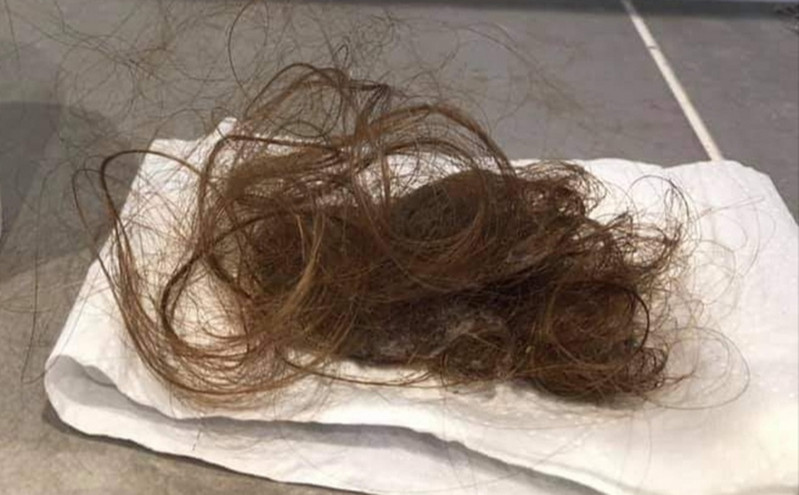 Κορονοϊός &#8211; Συγκλονιστικές μαρτυρίες ατόμων με long covid: «Έπεφταν τα μαλλιά μου, είχα αφόρητους πόνους»