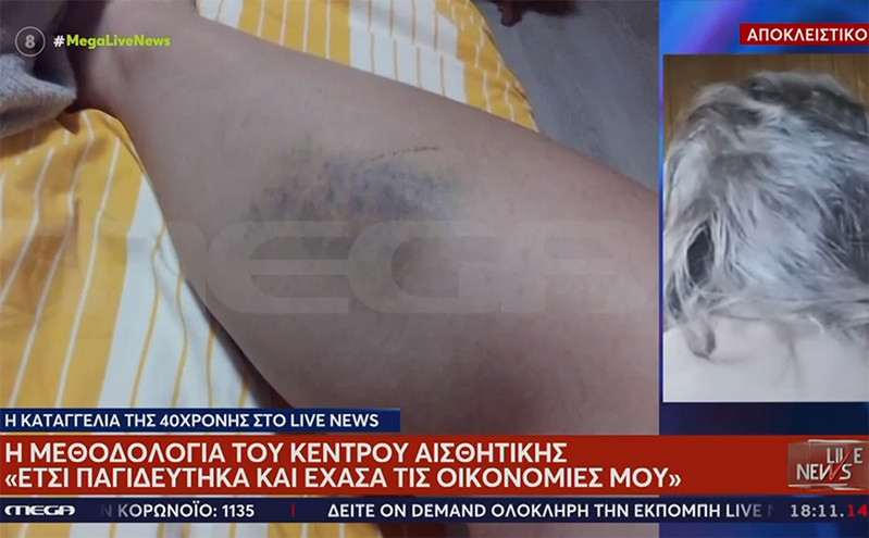 Θεσσαλονίκη: «Πήγα με καθαρό δέρμα και έφευγα με κοκκινίλες», λέει η γυναίκα που καταγγέλλει κέντρο αισθητικής