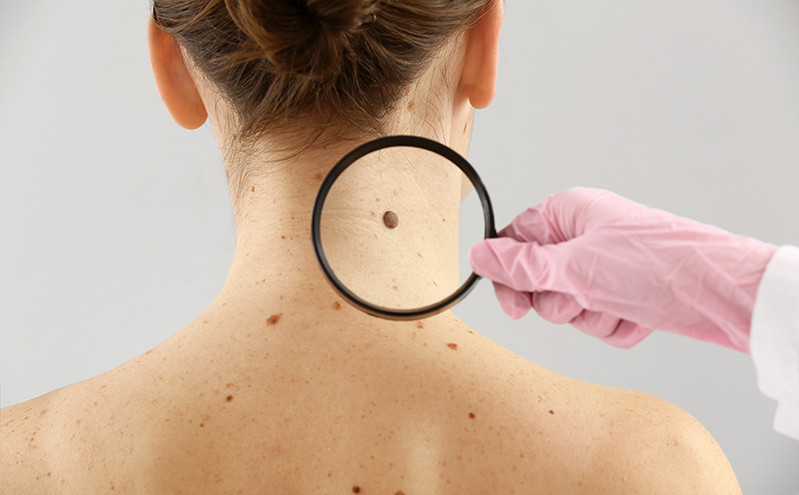Καρκίνος του δέρματος: Τα συμπτώματα και τα σημάδια που θέλουν προσοχή &#8211; Ειδικός εξηγεί