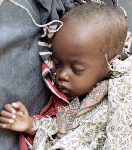 Σομαλία: Πάνω από μισό εκατομμύριο μικρά παιδιά αντιμετωπίζουν οξύ υποσιτισμό