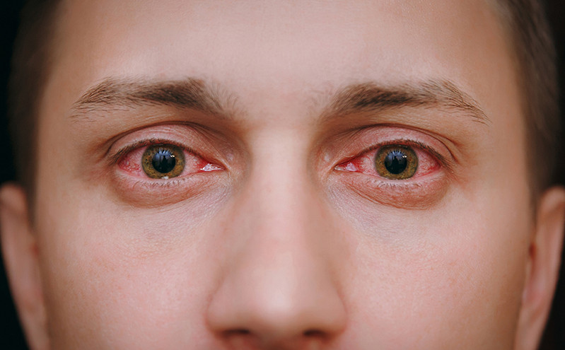 Πώς τα κόκκινα μάτια μπορεί να είναι σημάδι μιας θανατηφόρας βικτωριανής ασθένειας