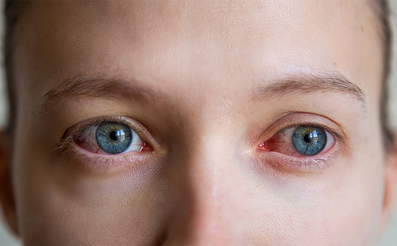 Επιπεφυκίτιδα και κόκκινα μάτια: Φταίει ο «Αρκτούρος» ή οι αλλεργίες;
