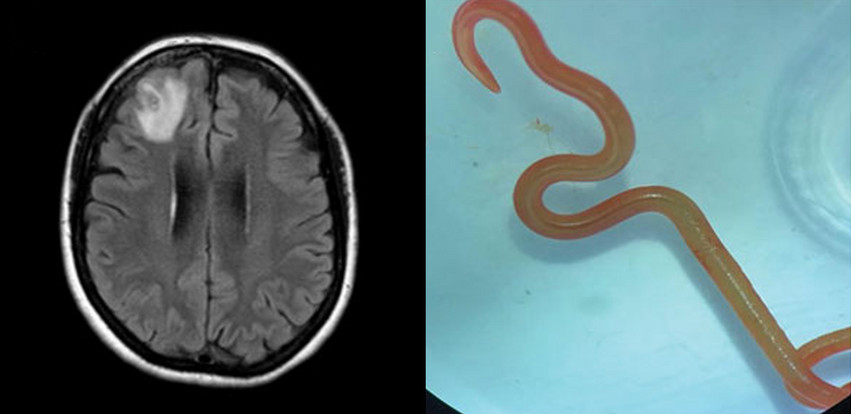 Ζωντανό σκουλήκι βρέθηκε στον εγκέφαλο γυναίκας &#8211; Η παγκόσμια πρώτη ανακάλυψη που άφησε άφωνους τους γιατρούς