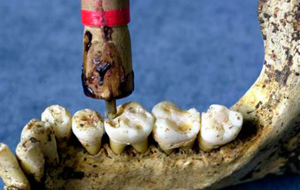 [Εικόνα: prehistoric_dentistry_EN.jpg?gravity=center]